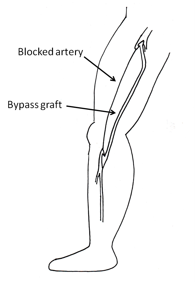 Bypass Figure Surgical Bypass