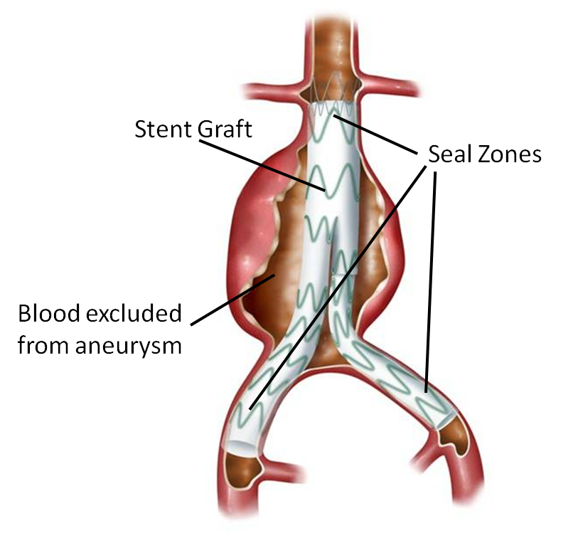 Endovascular Repair Fig 2