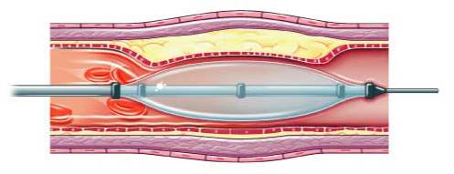 Angioplasty: A guide wire is passed across the narrowed or blocked segment of artery, A balloon is then inflated on the guidewire to stretch open the artery, which remains open when the balloon is withdrawn.