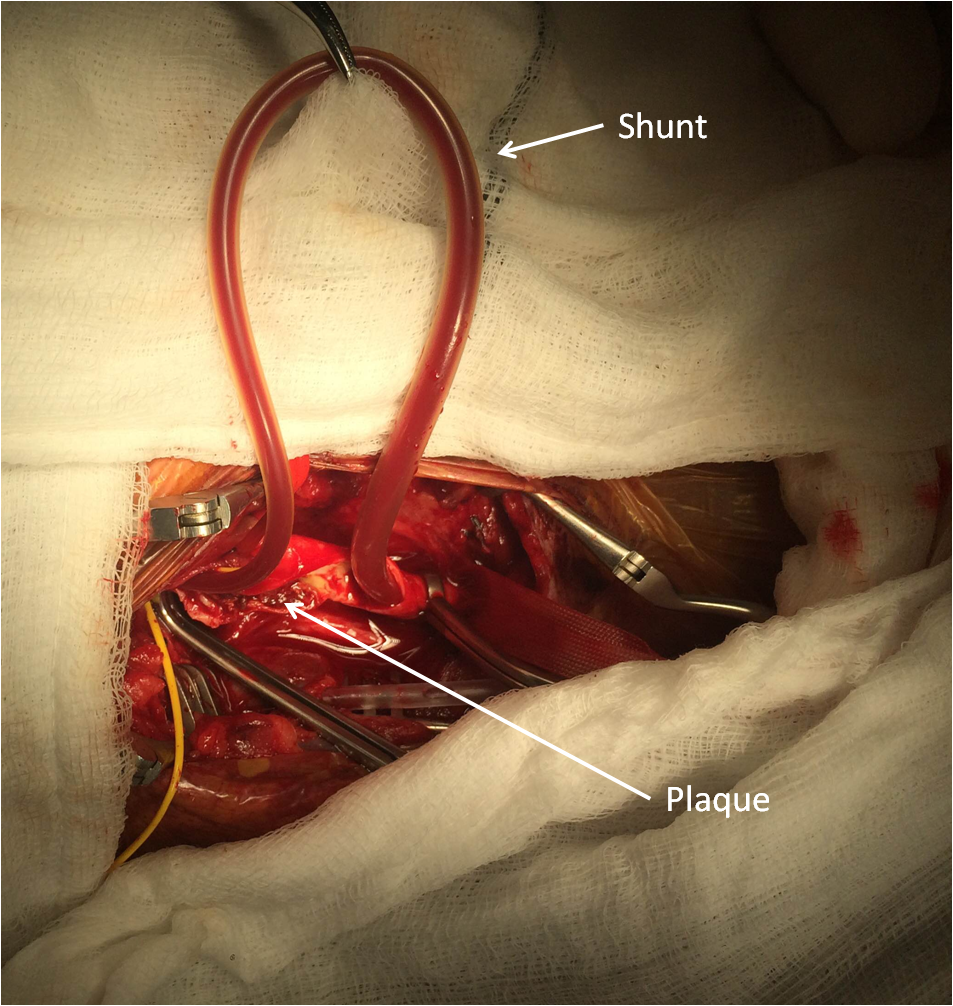Intraoperative image of carotid endarterectomy procedure. 