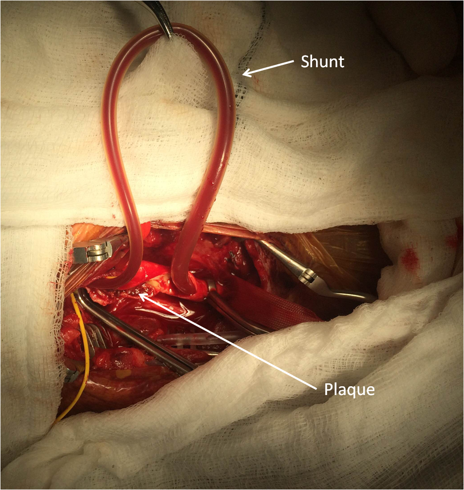 endarterectomy