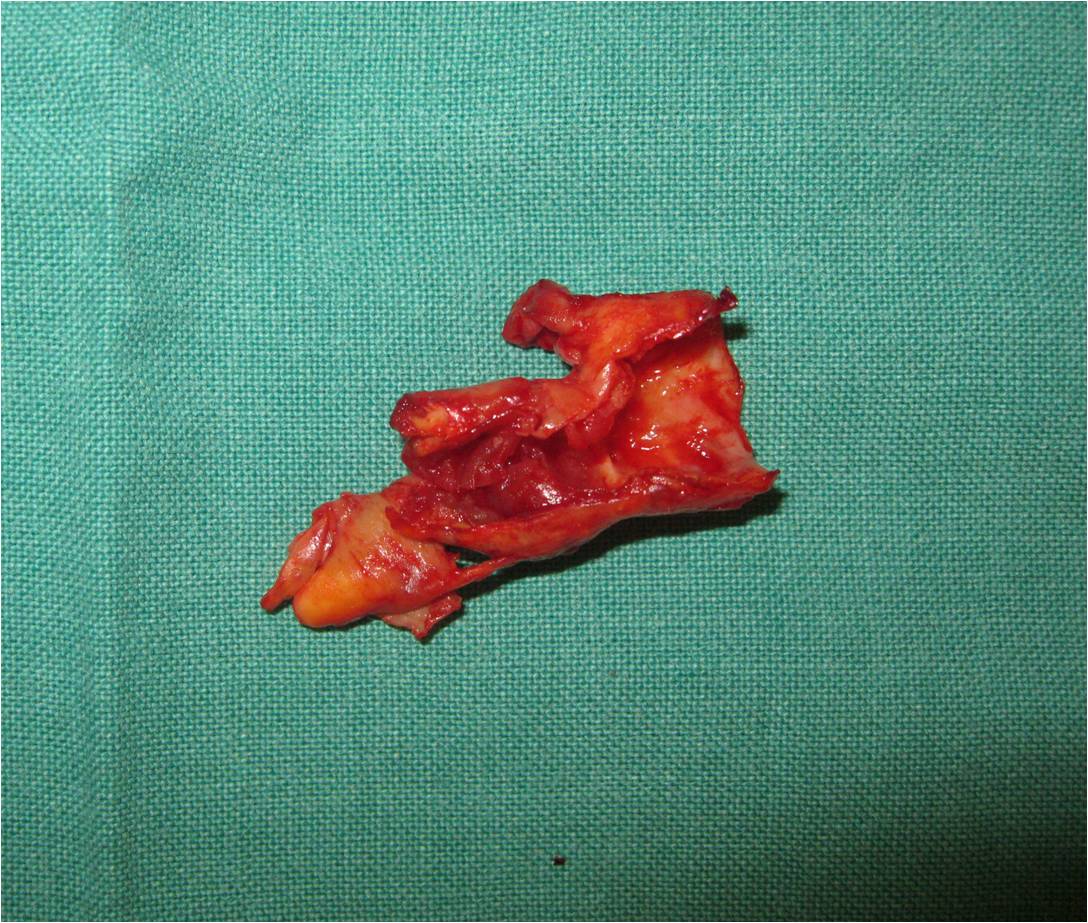 Close up view at atherosclerotic plaque removed at the time of carotid endarterectomy