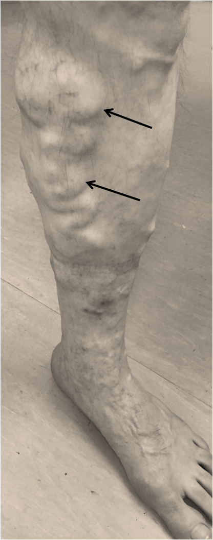 Figure Varicose Veins