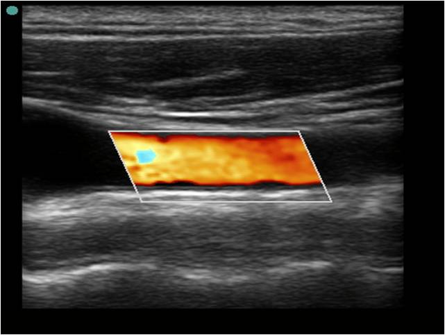 Carotid Artery Disease