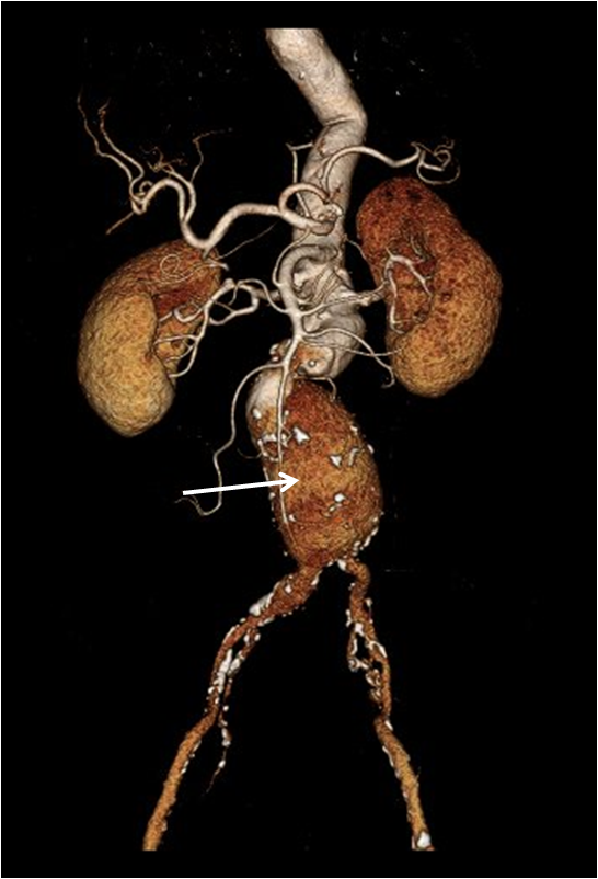 Figure1 Aortic Aneurysm