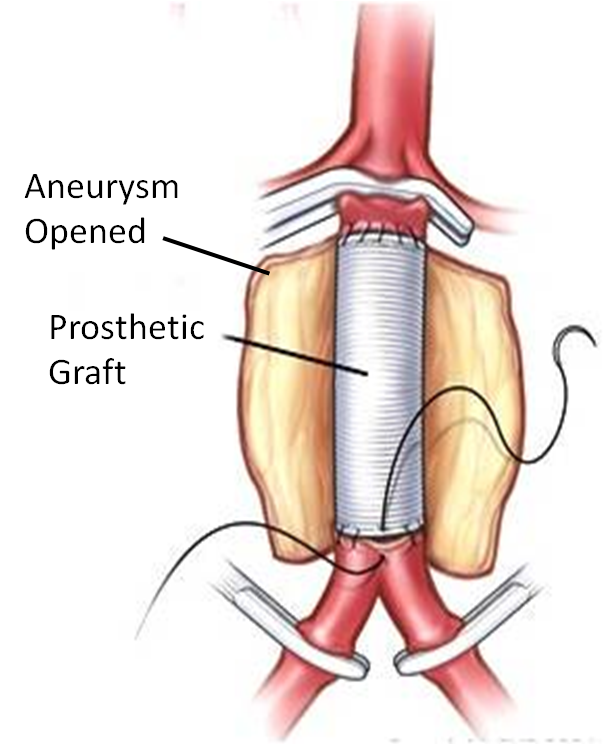 Open Aneurysm Fig 1