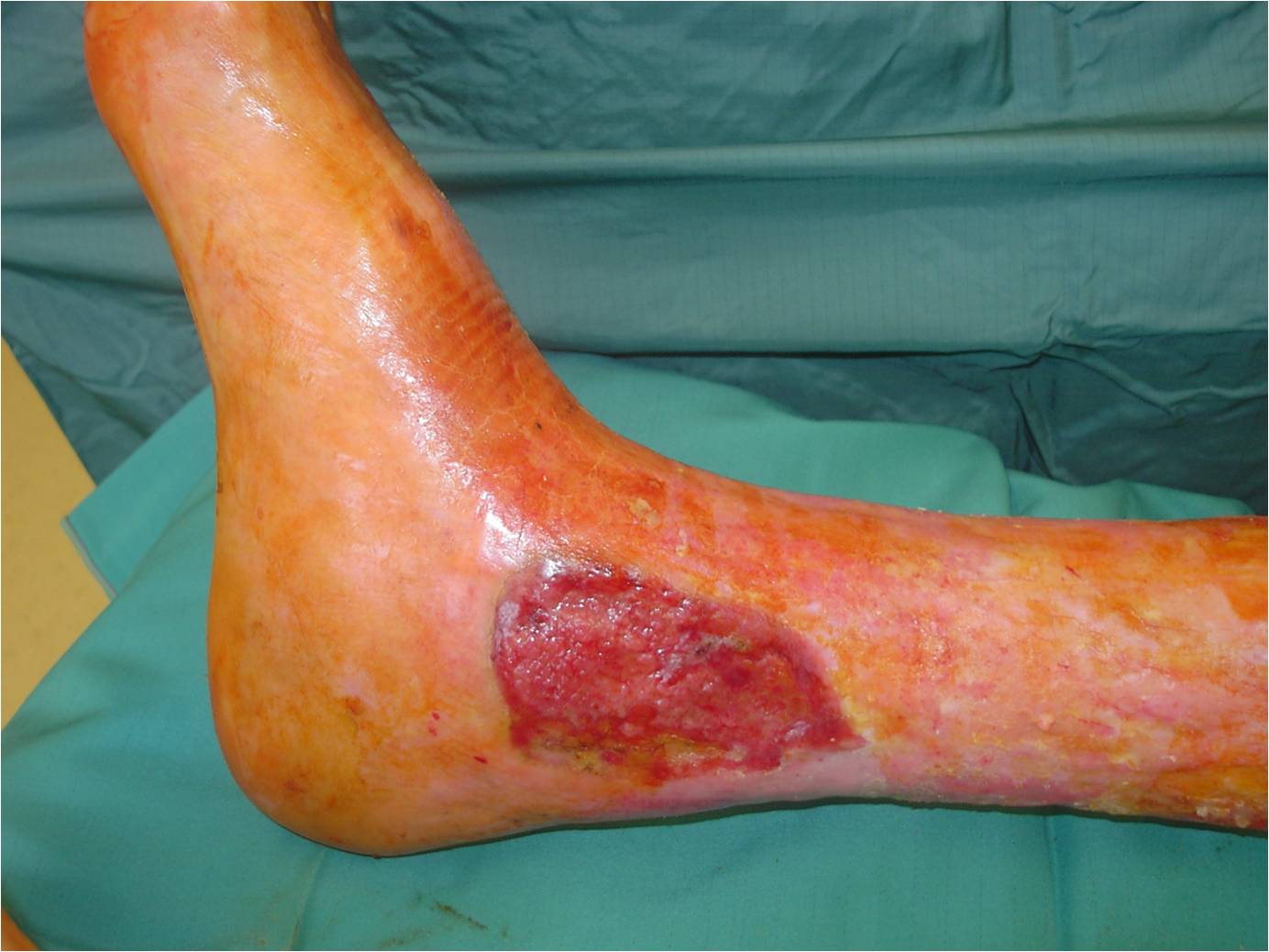 Picture1 Chronic Venous Insufficency