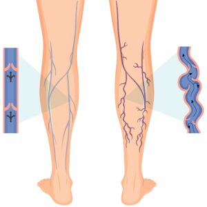 leg circulation treatment cork